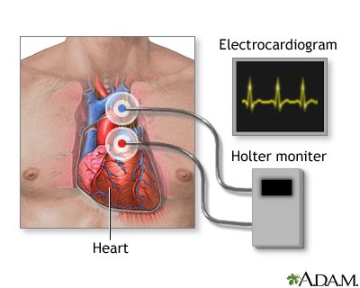 Holter Monitor, Heart Monitor, Heart Rhythms, Post Traumatic, Cpr, Medical School, Health Care, Medicine, Medical