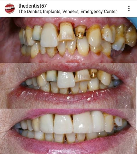 #Dentist #Dental_veneers There are many reasons why teeth may be yellow or stained and not look good over time. This can affect your confidence and stop you from smiling. Teeth naturally get yellow with age https://thedentistwestmidlands.co.uk/stained-and-yellow-teeth Messed Up Teeth, Dentistry Humor, Wallpaper Violet, Esthetic Dentistry, Iphone Wallpaper Violet, Holistic Dentistry, Dentistry Student, Aesthetic Dentistry, Restorative Dentistry