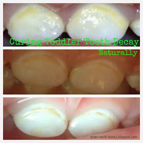 GreenEarthMama: Curing Toddler Tooth Decay Naturally Toddler Cavities, Cavity Remedy, Cavities In Kids, Toddler Tooth Decay, Baby Tooth Decay, Sensitive Teeth Remedy, Dental Decay, Tooth Decay Remedies, Teeth Whitening Homemade