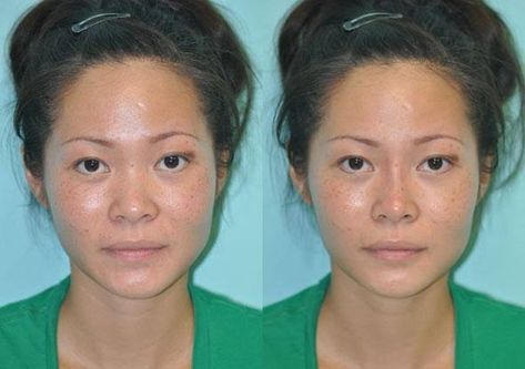 Asian Nose Job, Asian Nose, Nose Structure, Affirmation Lockscreen, Nose Fillers, Bulbous Nose, Lemon Face Mask, Rhinoplasty Nose Jobs, Nose Reshaping