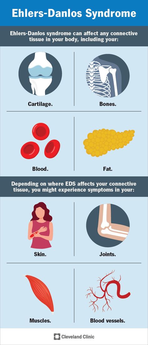 What Is Ehlers-Danlos Syndrome? Heds Symptoms, Hypermobile Ehlers Danlos Syndrome, Ehlers Danlos Awareness Month, Eds Hypermobility Test, Eds Ehlers Danlos Syndrome, Doogie Howser, Vascular Ehlers Danlos Syndrome, Ehlers Danlos Syndrome Symptoms, Ehlers Danlos Syndrome Types