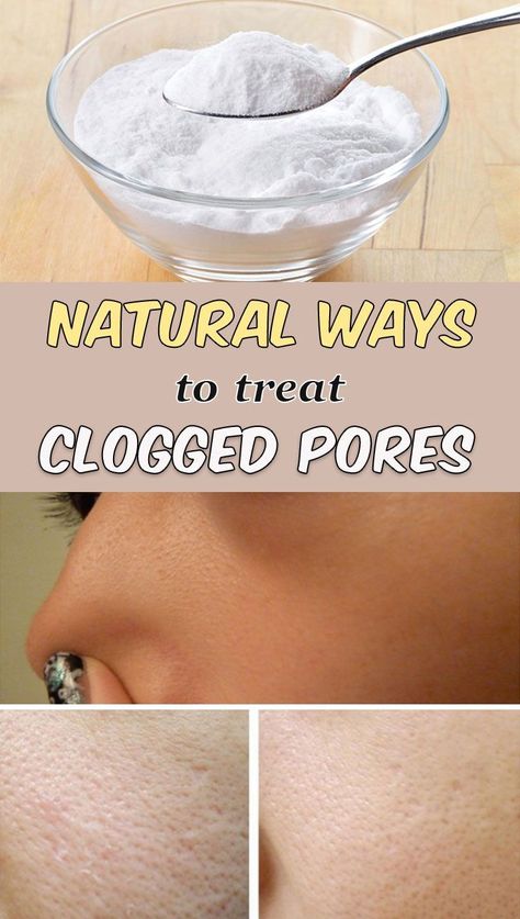 5 natural ways to treat clogged pores | by Moudnibemouaad | Medium Esthetician Treatments, Clean Nose Pores, Get Rid Of Clogged Pores, Brown Spots On Skin, Nose Pores, Skincare Acne, Pore Mask, Brown Spots On Face, Spots On Face