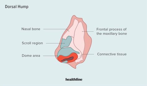 Dorsal Humps (Bump on Nose): Causes and More Noses With A Bump, How To Get Rid Of A Nose Bump, How To Get Rid Of Nose Bump Naturally, Bump On Nose, Dorsal Hump Nose, Women With Nose Bump, Neck Bump, Nose Bump, Family Health History