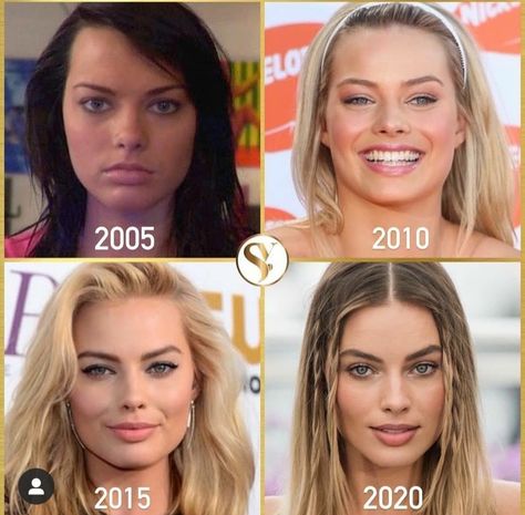 Extreme Plastic Surgery, Margot Robbie Style, Celebs Without Makeup, Facial Aesthetics, Celebrity Plastic Surgery, Celebrities Before And After, Nose Job, Lip Fillers, Margot Robbie