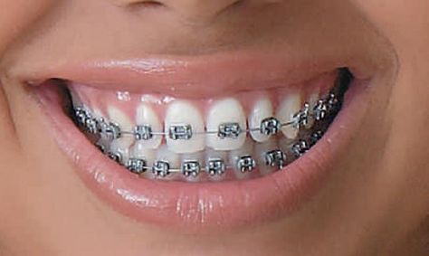 Cost OF Braces ? Braces Color Combos, Braces Transformation, Dental Braces Colors, Braces Colors Combinations, Braces And Glasses, Braces Cost, Cute Braces Colors, Adult Braces, Getting Braces