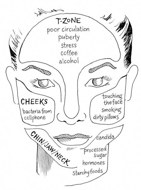 We're demystifying the face map with an Ayurvedic approach to why your t-zone, cheeks, or jawline acne is suffering from fits of acne or irritation. #skincaretips Doterra Acne, Gesicht Mapping, Cover Up Pimples, Dryskin Skincare, Jawline Acne, Face Map, Acne Hacks, Face Mapping Acne, Eyeliner Hacks