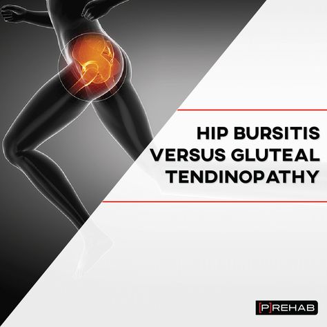 Hip Bursitis Versus Gluteal Tendinopathy Gluteal Tendinopathy, Hip Anatomy, Greater Trochanter, Glute Medius, Sports Physical Therapy, Bursitis Hip, Gluteal Muscles, Dry Needling, Muscle Spasms