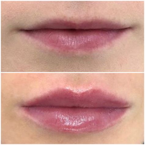 I've Got Small Lips But Im Worried About Getting Lip Fillers - L1P Aesthetics Natural Lip Fillers Small Lips, 1ml Lip Filler, Im Worried, Juvederm Lips, Lips Inspiration, Botox Lips, Light Makeup Looks, Facial Contouring, Small Lips