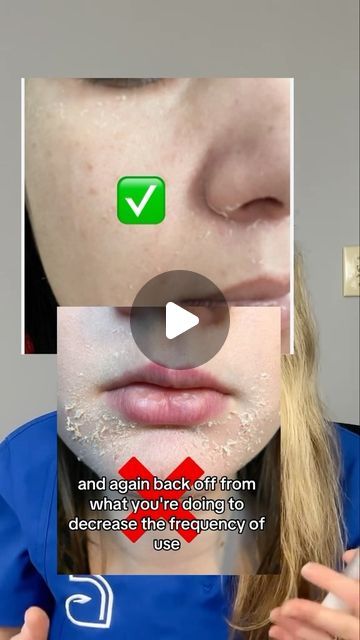 Dr. Abigail Waldman, MD FAAD on Instagram: "Curious about how long it will expect to see results from tretinoin? 

Dermatologist review of how long it will take to see results from tretinoin for acne, hyperpigmentation, skin texture and wrinkles. 

Also find out when to expect some of the common early side effects and know what’s normal and what’s not. 

Follow for more skin care tips. 

#acne #acnetreatment #tretinoin #antiaging #skincare #hyperpigmentation" Tretinoin Before And After Acne, Tretinoin Acne, Tretinoin Before And After, Skincare Hyperpigmentation, Before And After Acne, Acne Hyperpigmentation, Antiaging Skincare, How To Reduce Pimples, Pimple Marks