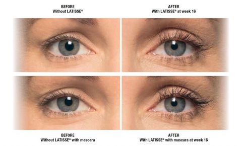 Before and After of Latisse Latisse Eyelashes, Medical Aesthetician, Grow Lashes, Make Up Studio, Laser Clinics, Eyelash Growth Serum, Eyelash Serum, Beautiful Lashes, Eyelash Growth