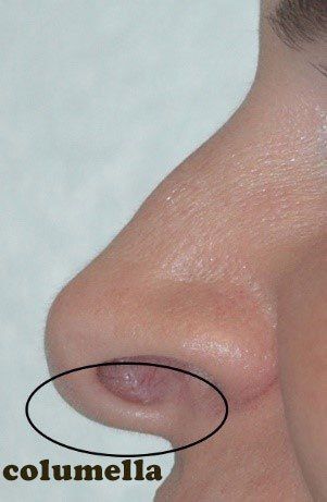 Correction of hanging columella by rhinoplasty - symptoms and causes Nasal Tip Rhinoplasty, Columella Surgery, Nostril Reduction Before And After, Nose Inspiration Rhinoplasty, Uneven Nostrils, Rhinoplasty Inspiration, Bad Nose Jobs, Nostril Reduction, Surgery Inspiration