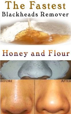 Covering Acne, Skin Moles, Black Heads, Clear Skin Tips, Acne Remedies, How To Get Rid Of Acne, Skin Care Solutions, Skin Care Recipes, Diy Skin Care