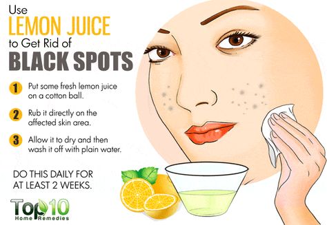 10 Home Remedies to Get Rid of Dark Spots on Face | Top 10 Home Remedies Black Spots On Face, Dark Spots Remedies, Top 10 Home Remedies, Dark Spots On Face, How To Get Rid Of Pimples, Dark Spots On Skin, Skin Spots, Spots On Face, Exterior Makeover