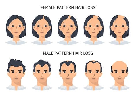 Hair loss stages androgenetic alopecia m... | Premium Vector #Freepik #vector #hair-growth #hair-follicle #hair-loss #human-skin Losing Hair Women, Female Facial Hair, Alopecia Hairstyles, Androgenetic Alopecia, Pattern Baldness, Female Hair, Lost Hair, Hair Fall, Male And Female