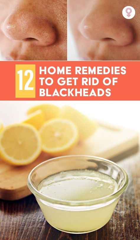 At Home Face Mask For Blackheads, How To Treat Chin Blackheads, Face Mask That Pulls Out Blackheads, Remove Blackheads From Nose Homemade, Home Remedy For Blackheads On Nose, How To Remove Blackheads, Blackhead Remedies, To Remove Blackheads, Rid Of Blackheads