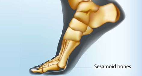 sesamoid bone foot, fracture, treatment, boca raton, florida Sesamoid Bone, Some People, Bones, Quick Saves