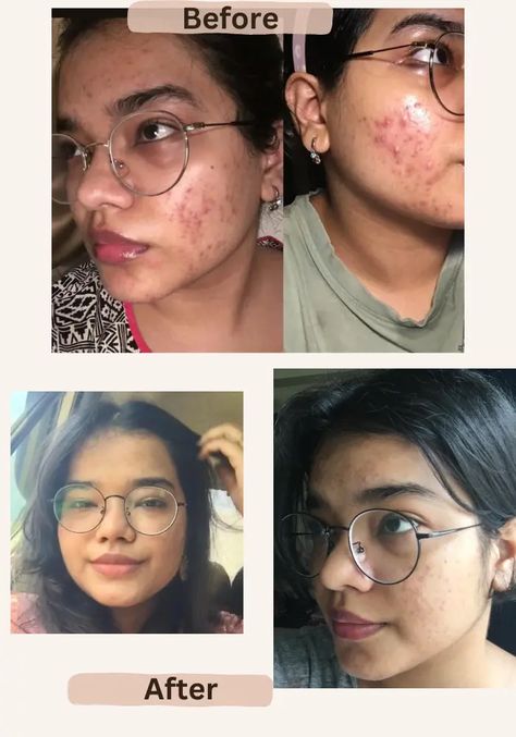 Tretinoin Before And After, People With Acne, Closed Comedones, Layers Of The Epidermis, Skincare Inspiration, Benzoyl Peroxide, Even Out Skin Tone, Progress Pictures, Best Skin