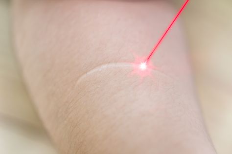 Am I a Good Candidate for Laser Scar Removal? Laser Scar Removal, Scar Massage, Hypertrophic Scars, Scar Reduction, Pimples Remedies, Acne Scar Removal, Coconut Oil For Skin, Scar Removal, Laser Therapy