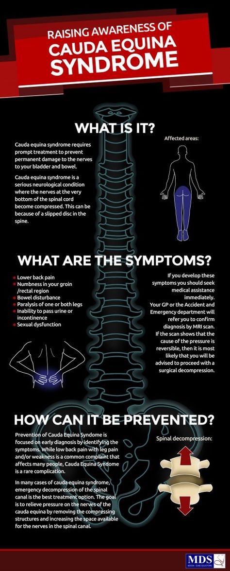 Cauda Equina, Sciatic Nerve Pain, Sciatic Nerve, Spinal Cord, Nerve Pain, Sciatica, Knee Pain, Nerve, Physical Therapy