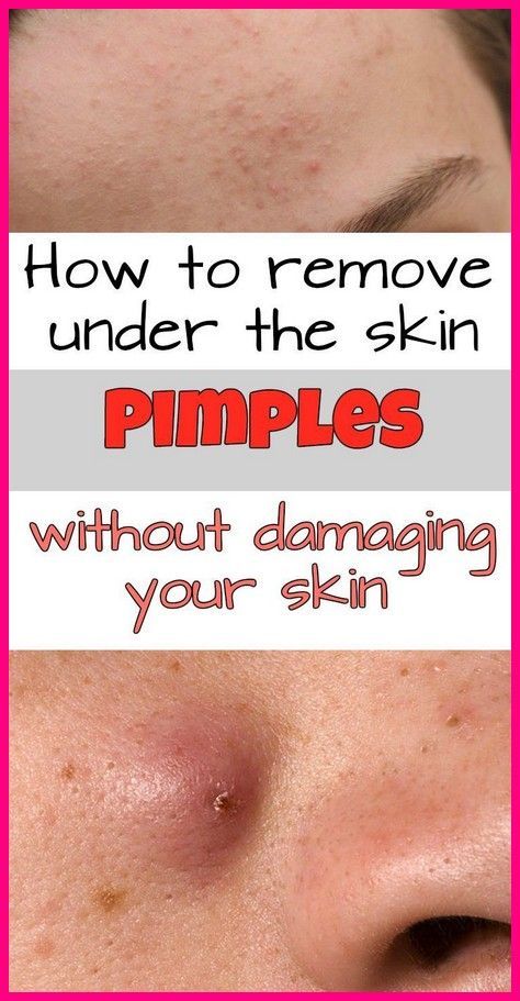 Under The Skin Pimples, Pimples Under The Skin, Under The Skin, How To Get Rid Of Pimples, Medicine Book, Acne Cream, Herbal Medicine, Diet Tips, The Skin