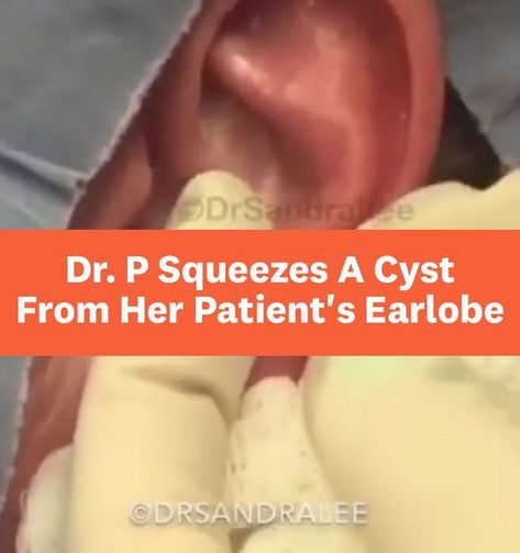 Cysts Popping Videos, Zit Popping Video Faces, Huge Blackheads, Big Zits, Huge Pimple, Ear Pimple, Baby Hat Sewing Pattern, Painful Pimple, Covering Acne