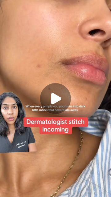 Dr. Neera Nathan | Do your pimples leave dark marks that don’t go away? I’m a board certified dermatologist and here’s why this happens and how to prevent &... | Instagram How To Deal With Acne, Nodule Acne, How To Fade, How To Reduce Pimples, Acne Dark Spots, Dark Spot Corrector, Pimple Marks, Natural Body Care, Fade Dark Spots