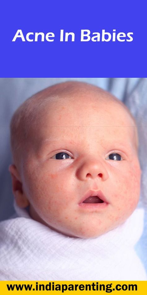 Acne In Babies Baby Acne, Prevent Acne, Newborn Care, Newborn Babies, After Baby, 2 Months, Skin Care Regimen, Baby Care, Newborn Photography