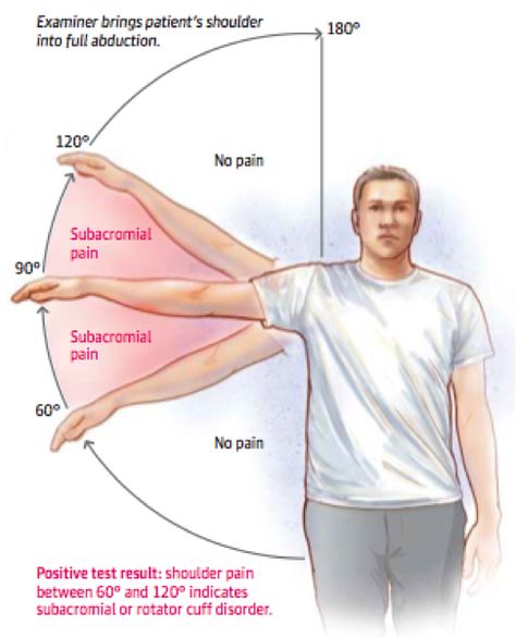 Research has shown up to 65% of all shoulder pain is related to shoulder impingement syndrome. 4 What does this mean and how can this condition be prevented? Shoulder Pain Remedies, Punkty Spustowe, Shoulder Rehab Exercises, Shoulder Anatomy, Shoulder Pain Exercises, Shoulder Rehab, Joints Pain Remedy, Shoulder Impingement, Shoulder Exercises