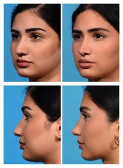 Nose Job Tip Reduction, Nose Job Before And After Front View, Nose Job Front Profile, Rhinoplasty Before And After Bulbous, Thick Skin Rhinoplasty, Nose Inspo Front View, Nose Job Inspiration Front View, Straight Nose Front View, Nose Job Inspo Front View