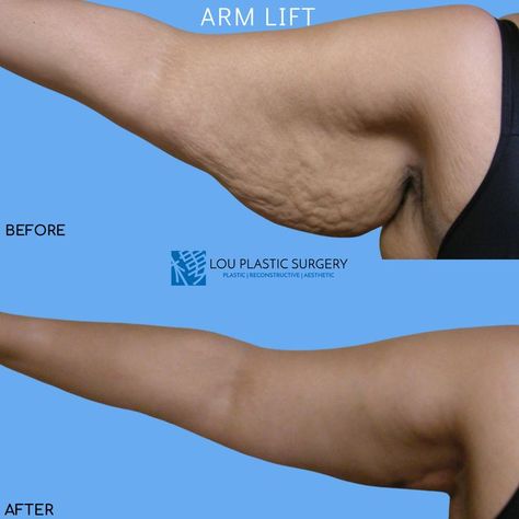 May your confidence in your arms be lifted with this transformation by Dr. Lou! 💪🥰 Thigh Lift Surgery, Arm Lift Surgery Before And After, Thigh Lift Surgery Before And After, Eyelid Lift Surgery Before After, Upper Eyelid Lift Surgery, Arm Lift Surgery, Arm Lift, In Your Arms, Plastic Surgery