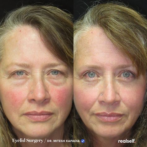 Eye Bag Removal Surgery, Eye Lid Surgery, Tighten Eyelids, Hooded Eyes Surgery, Eye Lift Before And After, Eye Surgery Before And After, Under Eye Surgery Before And After, Hooded Eye Surgery Before And After, Triple Eyelid