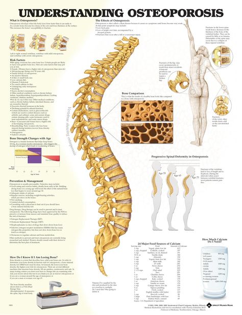 . Autoimmune Disease Awareness, Scientific Poster Design, Low Bone Density, Scientific Poster, Penyakit Jantung, Prevention Month, Bone Fracture, Medical Posters, Spine Surgery