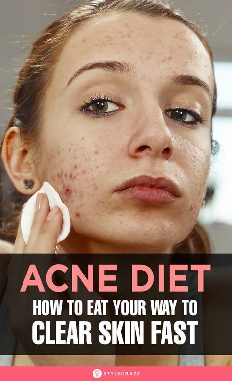 Anti Acne Diet, Acne Reasons, Clear Skin Fast, Acne Diet, Skin Diet, Acne Skincare Routine, Natural Acne Remedies, How To Get Rid Of Pimples, Glow Skin