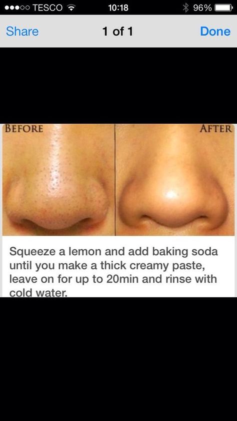 Obličejové Masky, Exposed Skin Care, Blackhead Remover Diy, Diy Acne, Smink Inspiration, Acne Remedies, Skin Pores, Skin Remedies, Dr Oz