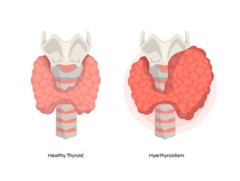 Thyroid health is important because the thyroid gland regulates essential body functions, including metabolism, energy levels, and overall well-being. let’s examine different thyroid disorders and discuss the best thyroid health tips. We will explain the types of thyroid problems, their symptoms, and why taking care of your thyroid is important. Thyroid Levels, Thyroid Symptoms, Types Of Diseases, Thyroid Medication, Thyroid Function, Thyroid Gland, Thyroid Health, Hormone Levels, Digestion Problems