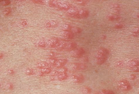 Pictures of STDs: Herpes, Genital Warts, Gonorrhea, STD Symptoms ... Common Skin Rashes, Itchy Rash, Home Remedies For Skin, Acne Causes, Skin Diseases, Home Remedies, Beauty Tips, Acne, Skin