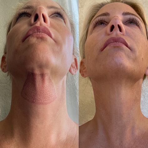 Plasma Fibroblasting Before & After Pictures - RealSelf Sonobello Before And After, Plasma Pen, After Pictures, Before And After Pictures, Anti Aging, Pen