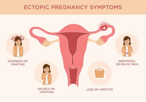 A reliable Private Ultrasound Scan clinic in Reading has a detailed discussion of everything you need to know about ectopic pregnancy. Pregnancy Ultrasound, Endocrine Disorders, Ectopic Pregnancy, High Risk Pregnancy, Female Reproductive System, Feminine Health, Polycystic Ovaries, Prenatal Care, Pelvic Pain