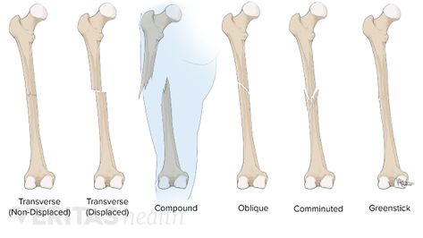 The words broken bone and fracture both refer to a break in the bone that occurs when an outside force is too great for the bone to handle. Learn about the different types of fractures that can occur. Breaking Bones, Radius Bone, Study Binder, Open Fracture, Types Of Fractures, Emt Study, Cardiac Cycle, Hairline Fracture, Types Of Bones