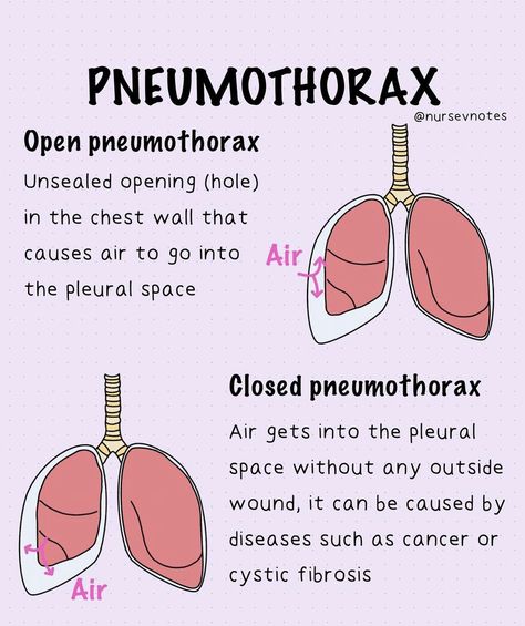 Respiratory Therapy Aesthetic, Respiratory Therapy Student Notes, Respiratory Nursing, Nicu Respiratory Therapist, Respiratory Therapist Notes, Pathophysiology Nursing Study Guides Respiratory, Respiratory Therapy Normal Values, Emt Basic, Respiratory Therapy Notes