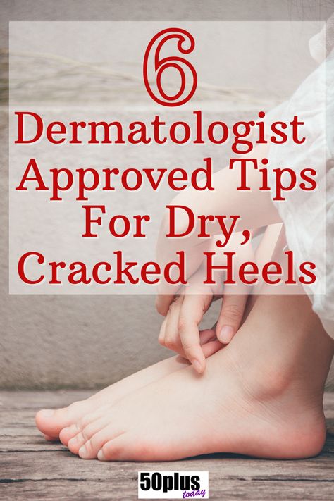 Hate dry cracked heels? Here's how to heal them and in the future - prevent them! Dermatologist recommended. #dermatologist #skincare #winterskin #crackedheels #drycrackedheels #50plus #seniors #uglyfeet Dry Cracked Feet Home Remedy, How To Remove Dry Skin From Heels, Cracked Feet Remedies Heels, How To Soften Heels, Soft Heels Remedies, How To Get Rid Of Rough Heels, How To Get Rid Of Dry Feet Skin, Heel Softener Remedies, How To Heal Cracked Feet Fast