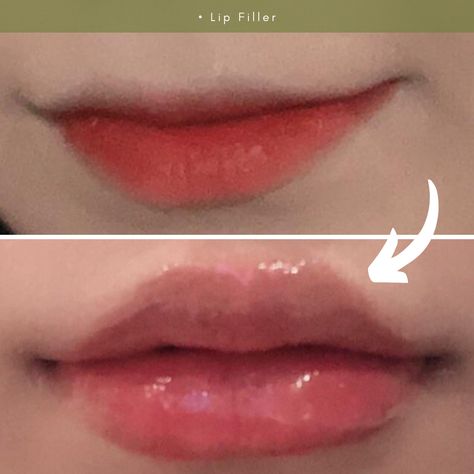 Korean Lip Filler Before And After, Korean Lip Filler, Korean Lips, Lip Filler, Cherry Lips, Skin Clinic, Lip Fillers, Korean Skincare, Skin Treatments