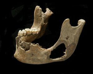 Individual 69's mandible showing the destruction to the bone, via Roberts et al. 2016 Phossy Jaw, Biological Anthropology, Radium Girls, Vintage Anatomy, Front Teeth, American Illustration, History Nerd, Brave Women, To The Bone