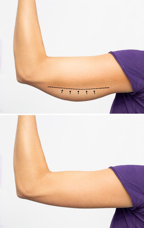 Exercising your arms, but the best way to fix the stretched skin is to go for an arm lift cosmetic surgery. There are a lot of questions that naturally come to our mind about arm lift surgery. Let us find them out. Arm Surgery, Arm Lift Surgery, 2025 Board, Arm Lift, Leg Lifts, Sagging Skin, 2024 Vision, Cosmetic Surgery, Cole Haan Zerogrand Oxford