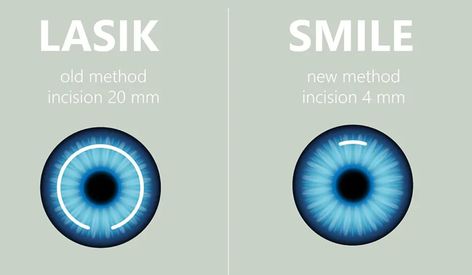 Are you facing problems finding the best hospital for lasik eye surgery in dehli? Don't worry we got you covered! Read More to know what precautions you need to consider before going for smile lasik eye surgery. Know wht are the most advanced ways to minimize the precautions that might occur in smile eye surgery. Lasik Eye Surgery, Laser Eye Surgery, In Smile, Laser Eye, Doctors Note, Eye Surgery, Best Hospitals, Hair Removal Cream, 2024 Vision