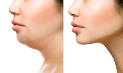 Double Chin Reduction, Double Chin Removal, Double Menton, Cool Sculpting, Chubby Cheeks, Fat Removal, Loose Skin, Double Chin, Skin Tightening