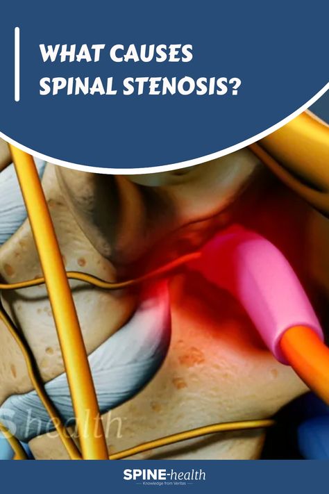 Illustration of spinal stenosis with highlighted constriction area, featuring text asking, "What causes spinal stenosis?" Spinal Canal Stenosis Exercises, Spinal Cord Diagram, Spinal Nerves Anatomy, Stenosis Of The Spine, Spinal Cord Anatomy, Spinal Degeneration, Nerve Anatomy, Health Websites, Spinal Decompression