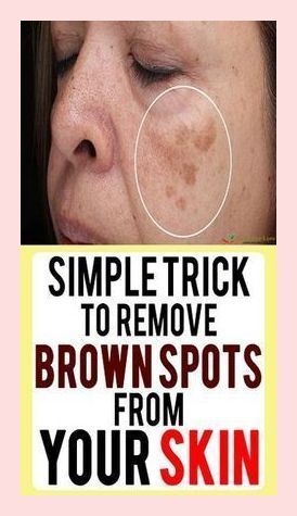 SIMPLE TRICK TO REMOVE BROWN SPOTS FROM YOUR SKIN Spots On Skin, Brown Spots On Skin, Brown Spots On Face, Spots On Face, Baking Soda Shampoo, Belly Fat Burner Drink, Short Choppy Hair, Fat Burner Drinks, Brown Spots