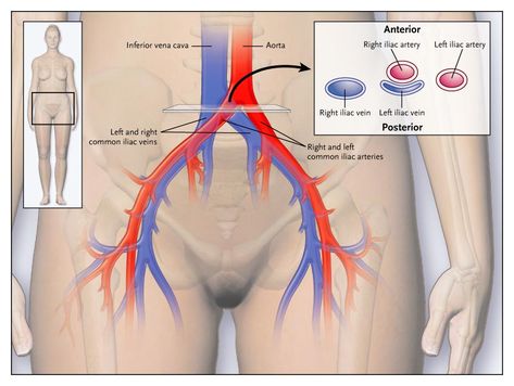 may-thurner Psoas Muscle Pain, Pelvic Congestion Syndrome, Vascular Ultrasound, Leg Ulcers, Diagnostic Medical Sonography, Vascular Surgery, Venous Insufficiency, Abdominal Surgery, Medication Management