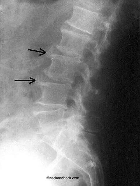 Idiopathic Skeletal Hyperostosis | Forestier's Disease | Vail, CO Orthopedic Spine Surgeon by neckandback, via Flickr Vail Co, Watch Your Back, X Rays, Medical Field, Anatomy And Physiology, Radiology, Skeletal, Chiropractic, X Ray